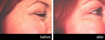Anti-wrinkle neorotoxin injections  before and after - eyes