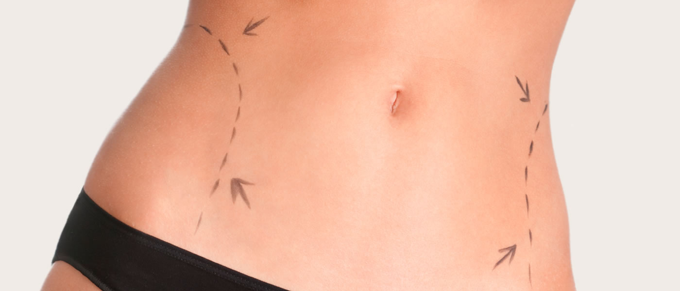 Liposuction by Dr Feldman in Melbourne