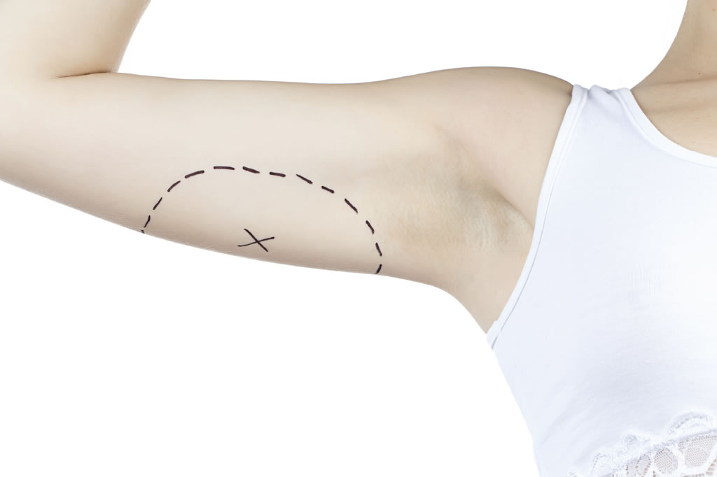Tumescent Arm Liposuction