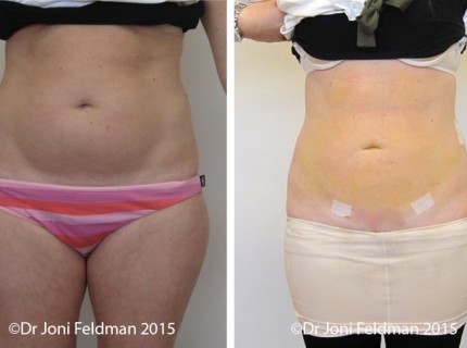 Abdominal or Tummy Liposuction by Dr Joni Feldman in Melbourne