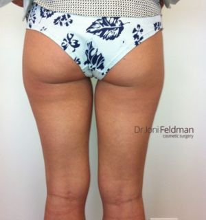 BEFORE - Thigh liposuction by Dr Joni Feldman - Melbourne