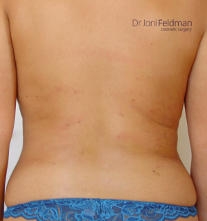 Back liposuction - AFTER - Dr Joni Feldman in Melbourne