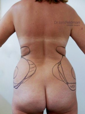 BEFORE photo hips liposuction by Dr Feldman in Melbourne