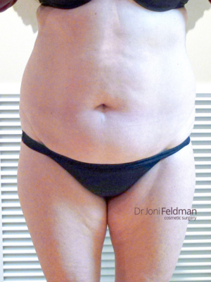 Abdominal liposuction - before photo - by Dr Joni Feldman in Melbourne