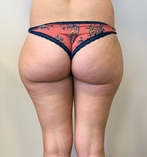 Thigh Liposuction -Dr Joni Feldman - Melbourne