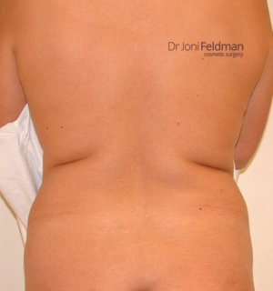 Back liposuction - BEFORE - Dr Joni Feldman in Melbourne