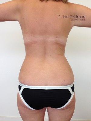 AFTER PHOTO - hips liposuction by Dr Feldman in Melbourne