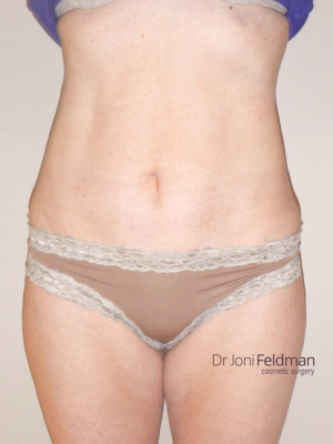 Abdominal liposuction - AFTER PHOTO - by Dr Joni Feldman in Melbourne