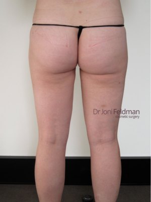 Thigh liposuction - rear - AFTER - Dr Joni Feldman in Melbourne