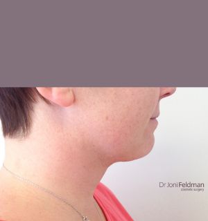 After Chin and Neck liposuction - Dr Joni Feldman - Melbourne