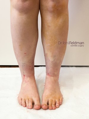 ankle liposuction - AFTER - by Dr Joni Feldman - Melbourne