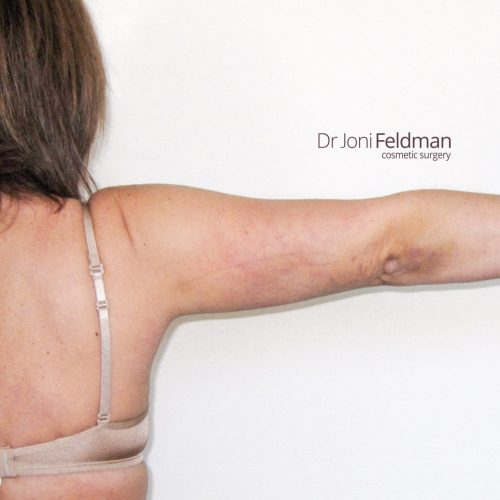 Arm liposuction -AFTER - Dr Joni Feldman in Melbourne