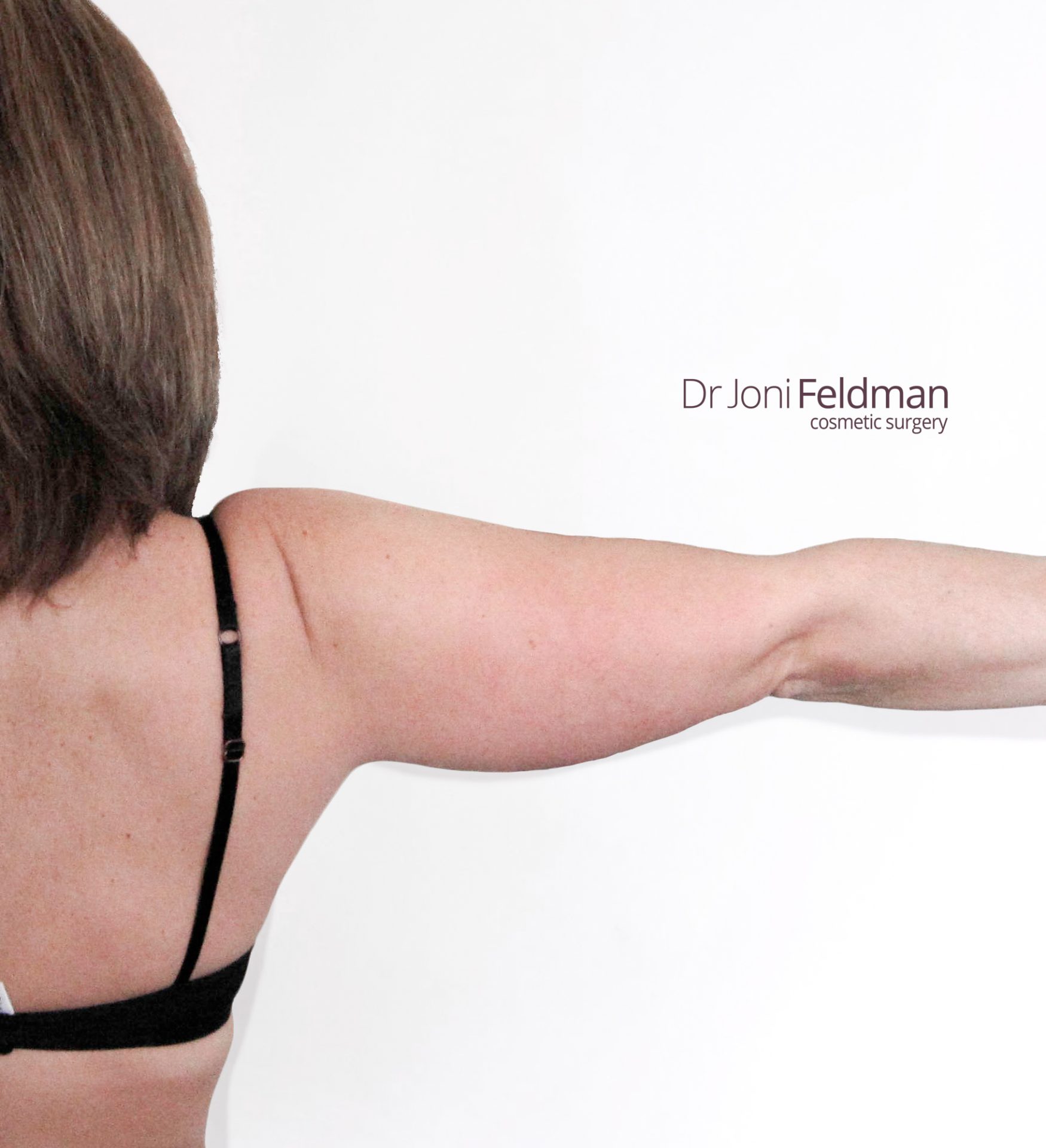 Arm liposuction -BEFORE - Dr Joni Feldman in Melbourne