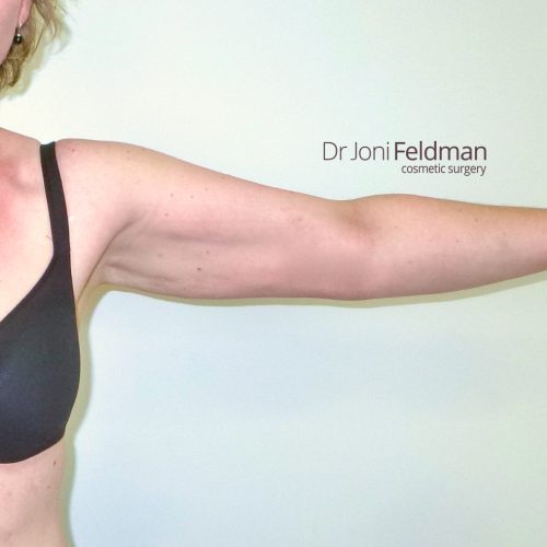 Arm liposuction -after - Dr Joni Feldman in Melbourne
