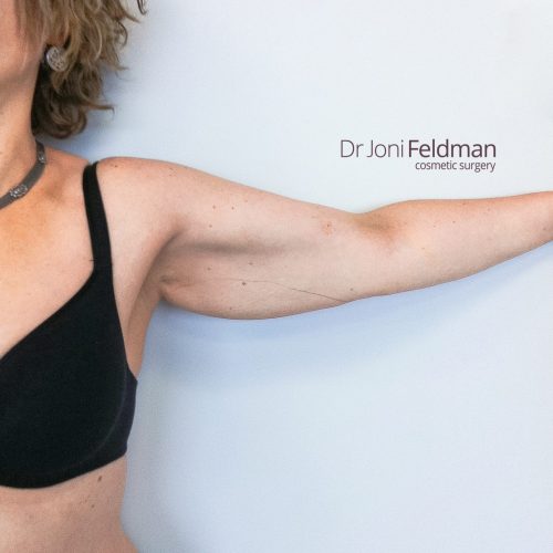 Arm liposuction -BEFORE - Dr Joni Feldman in Melbourne