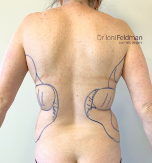 Back liposuction -BEFORE - Dr Joni Feldman in Melbourne