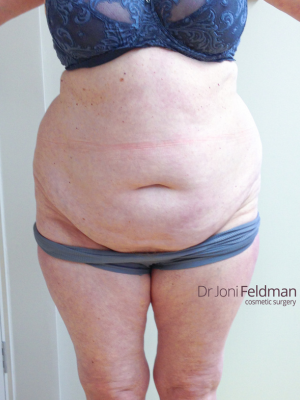 Abdominal liposuction by Dr Joni Feldman in Melbourne