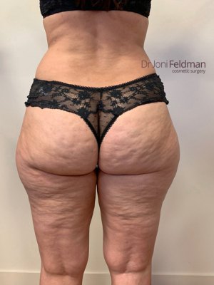 BEFORE thigh liposuction by Dr Feldman in Melbourne