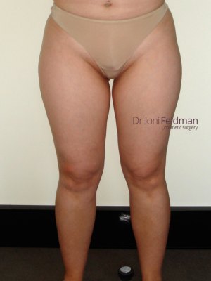 Thigh liposuction - FRONT - BEFORE - Dr Joni Feldman in Melbourne