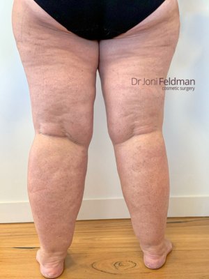 Leg and ankle liposuction - BEFORE - by Dr Joni Feldman - Melbourne