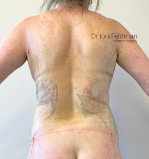 Back liposuction -AFTER - Dr Joni Feldman in Melbourne