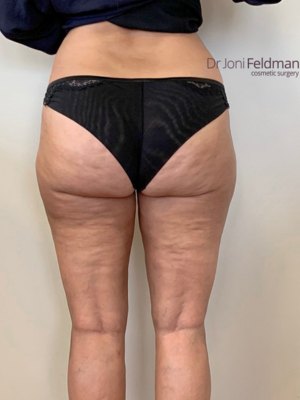 AFTER thigh liposuction by Dr Feldman in Melbourne