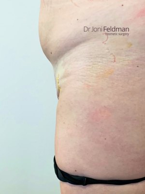 FUPA Mons pubis Liposuction - AFTER -Dr Joni Feldman - Melbourne