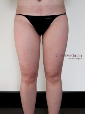 Thigh liposuction - front - AFTER - Dr Joni Feldman in Melbourne