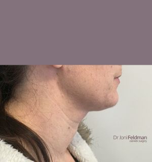 After Chin and neck liposuction - Dr Joni Feldman - Melbourne