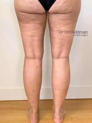 Leg and ankle liposuction - AFTER - by Dr Joni Feldman - Melbourne