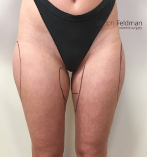 Thigh Liposuction - before - Dr Joni Feldman - Melbourne