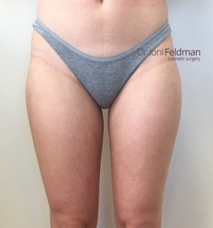 Thigh Liposuction -AFTER - Dr Joni Feldman - Melbourne