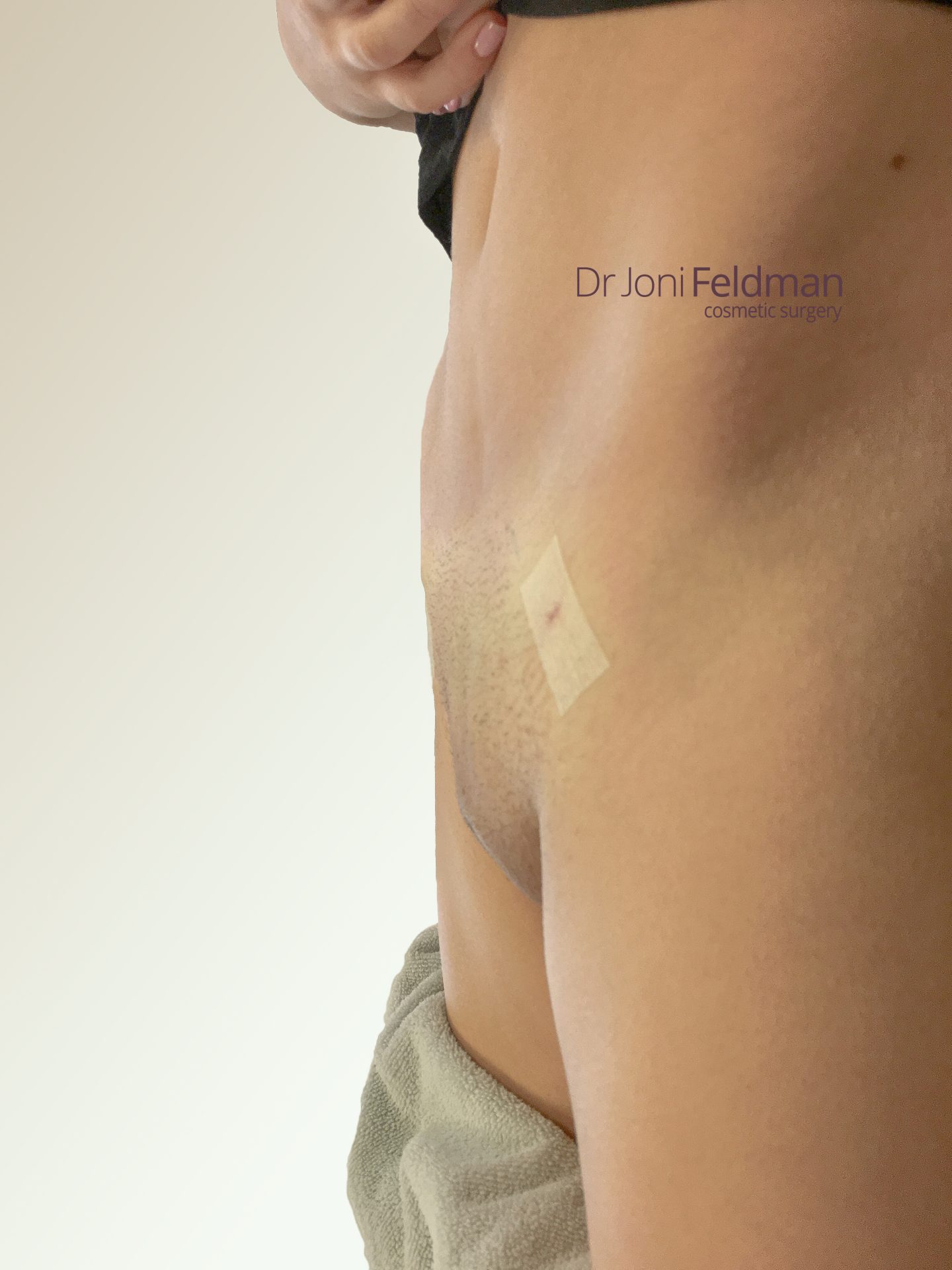 FUPA Mons pubis Liposuction - AFTER -Dr Joni Feldman - Melbourne
