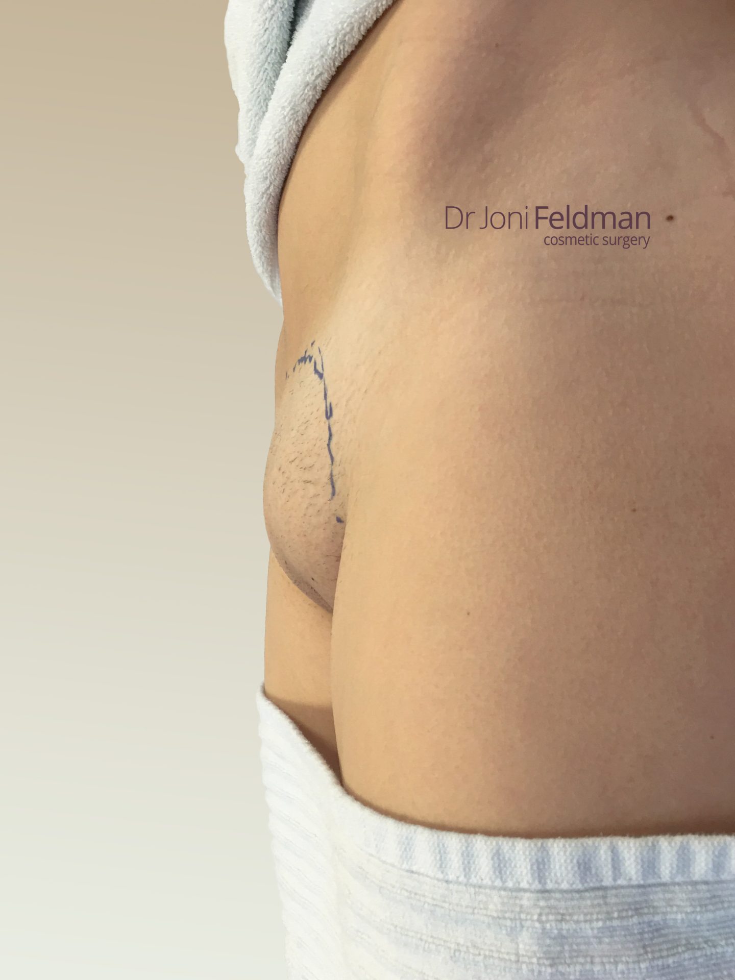 FUPA Mons pibis Liposuction - BEFORE -Dr Joni Feldman - Melbourne