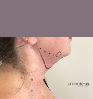 Before Chin and neck liposuction - Dr Joni Feldman in Melbourne