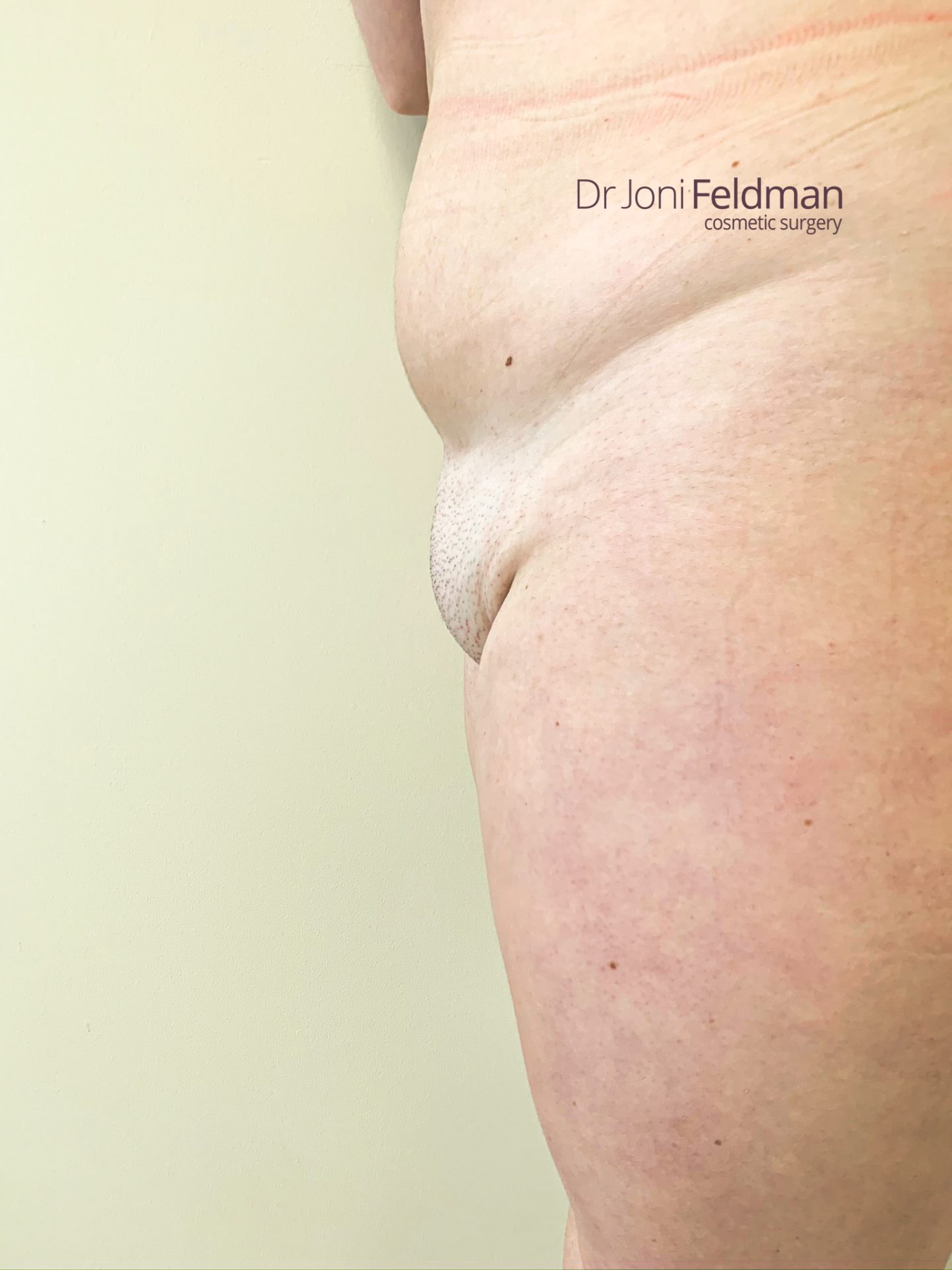 FUPA Mons pubis Liposuction - BEFORE -Dr Joni Feldman in Melbourne
