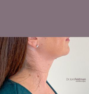 After Chin jaw and neck liposuction - Dr Joni Feldman - Melbourne