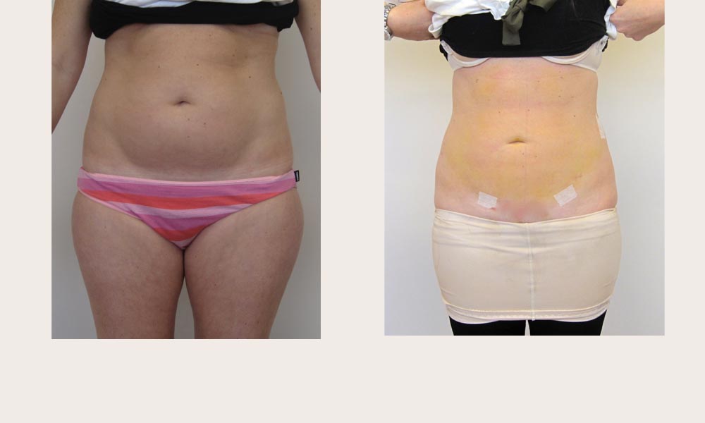 Before & after Tummy Lipo by Dr Joni Feldman in Melbourne