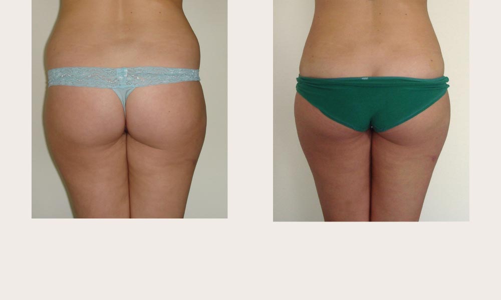 Before & after abdominal & hips Liposuction by Dr Joni Feldman in Melbourne