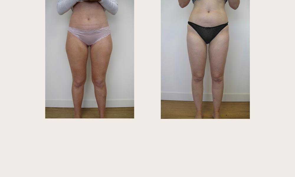 Knee Lipo - before & after by Dr Joni Feldman in Melbourne